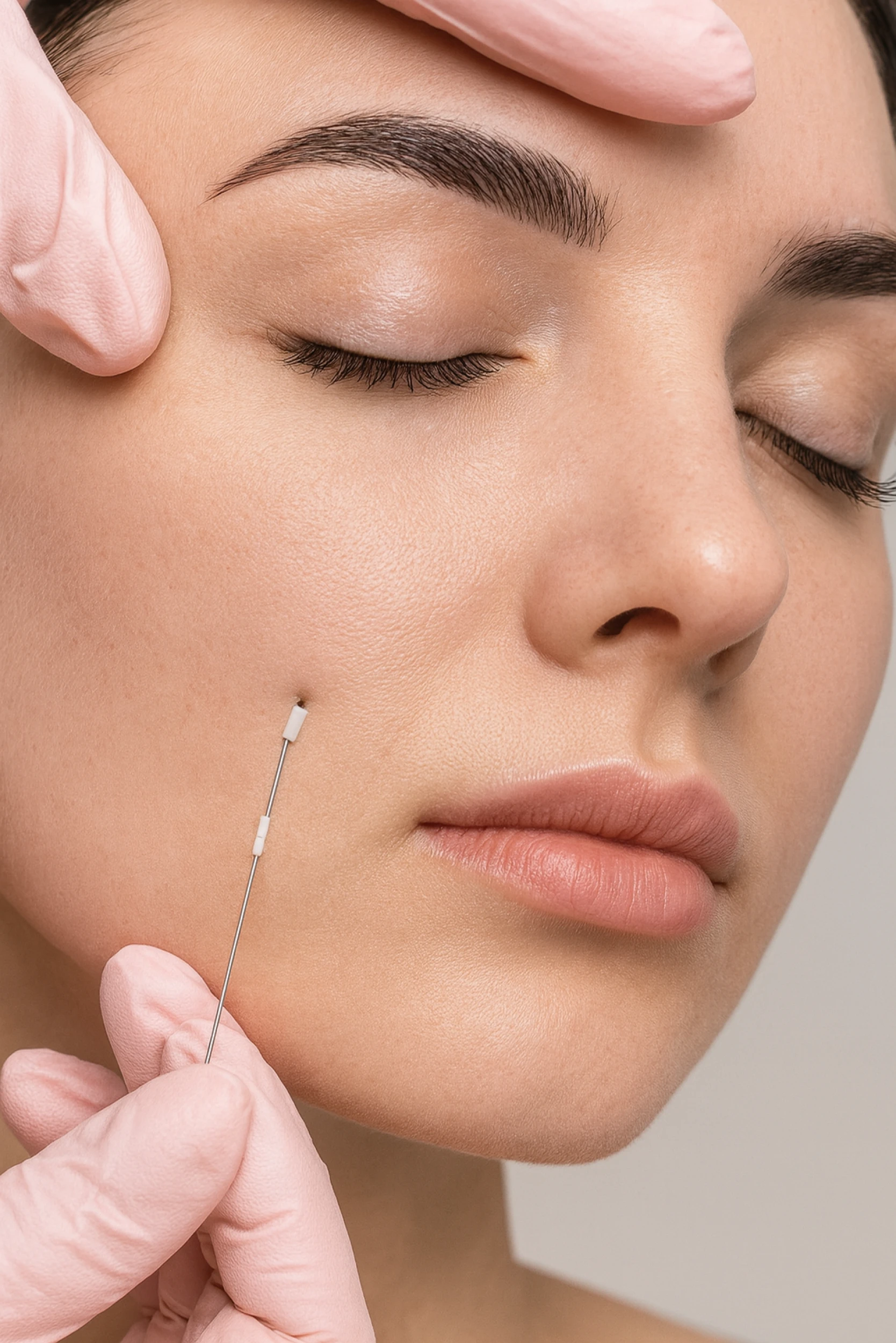 Fios de PDO - procedimento estético para lifting e sustentação da pele